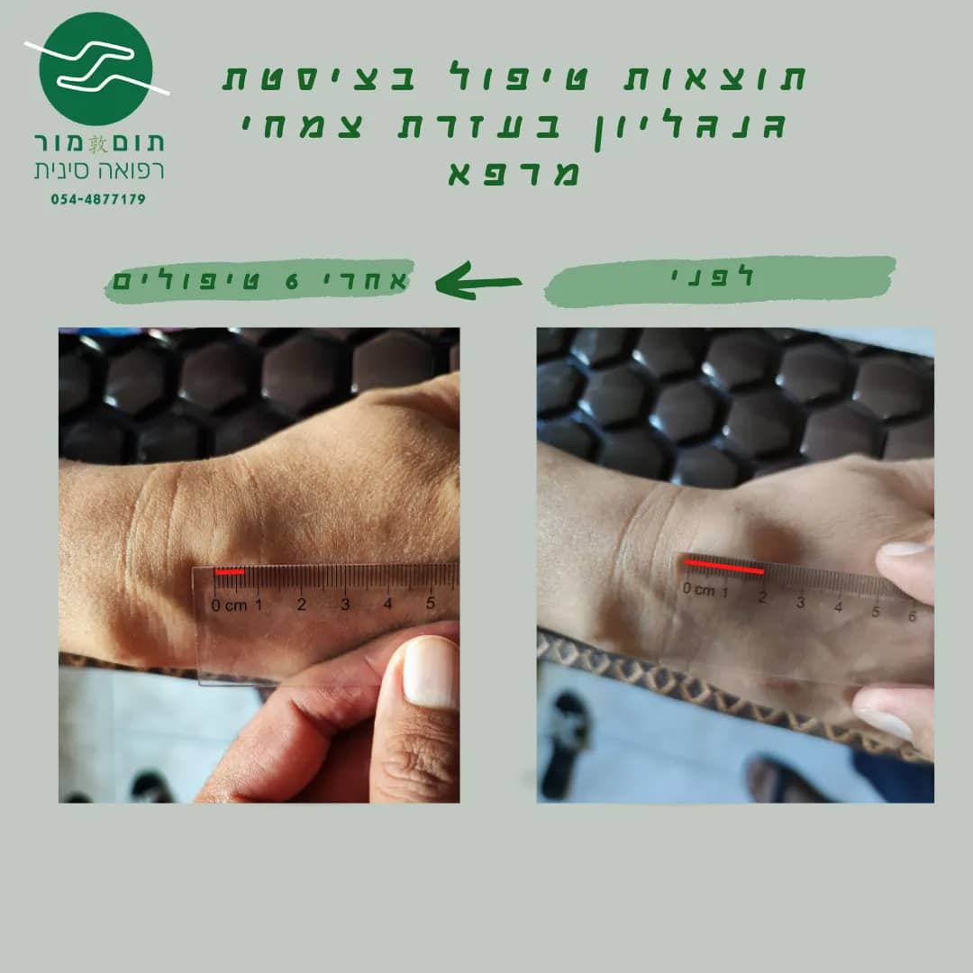 תוצאות טיפול בציסטת גנגליון בעזרת צמחי מרפא תוצאות טיפול בציסטת גנגליון בעזרת צמחי מרפא