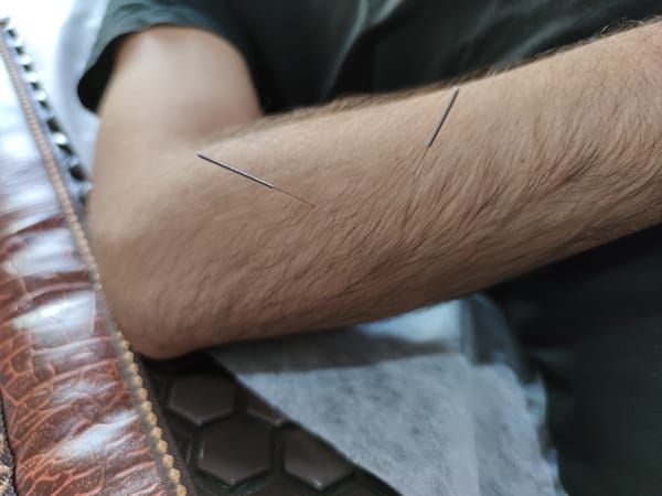 דיקור סיני לטיפול בכאב נוירופתי דיקור סיני לטיפול בכאב נוירופתי